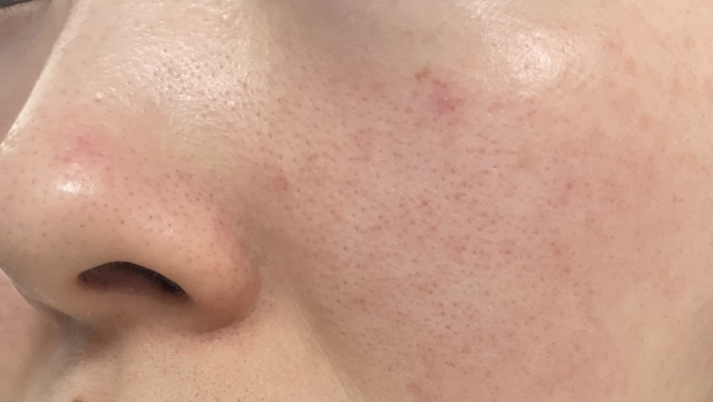 毛穴の開きでお悩みの方へ
