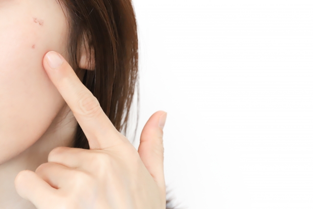 ニキビ・ニキビ跡でお悩みの方へ