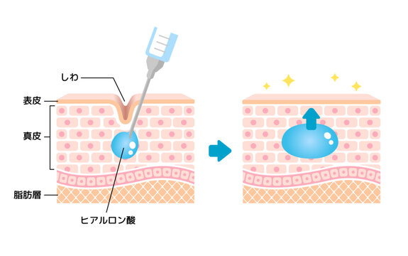 ヒアルロン酸とは
