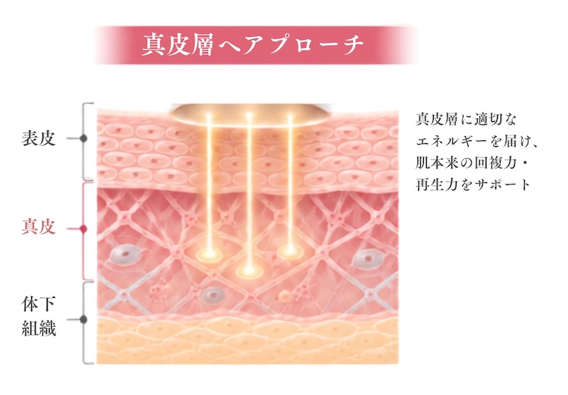 真皮リモデリング